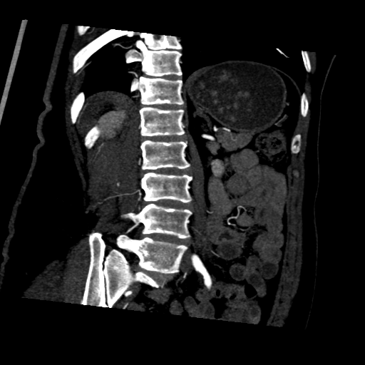 File:Normal CT renal artery angiogram (Radiopaedia 38727-40889 D 17).png