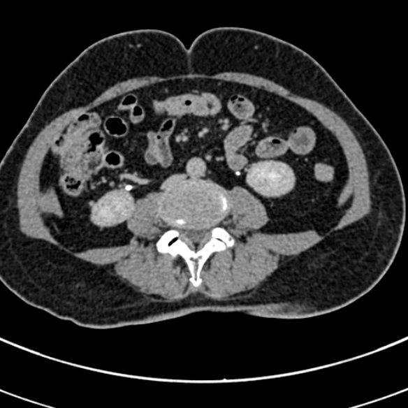 File:Normal CT split bolus study of the renal tract (Radiopaedia 48631-53634 Axial split bolus 148).jpg