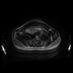 Normal MRI abdomen in pregnancy (Radiopaedia 88001-104541 Axial DWI 97).jpg