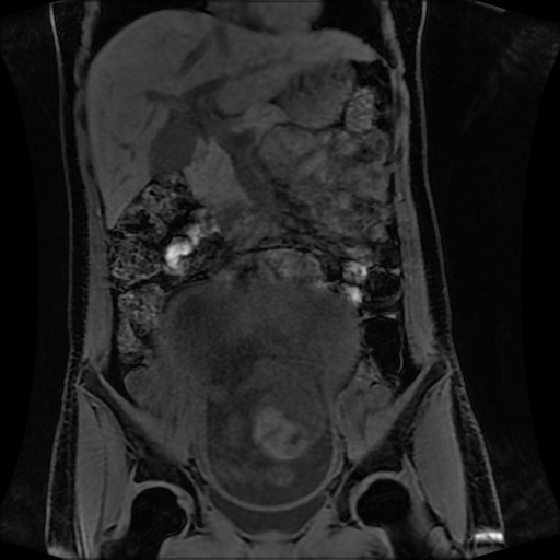 Normal MRI abdomen in pregnancy (Radiopaedia 88001-104541 M 64).jpg