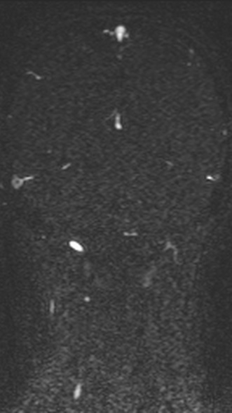 Normal MRI brain with MRV- teenager (Radiopaedia 49425-54553 Coronal MRV 178).jpg
