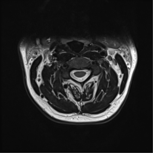 File:Normal MRI cervical spine (infection protocol) (Radiopaedia 53916-60039 Axial T2 19).png