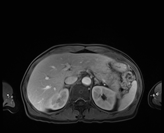 Normal adrenal glands MRI (Radiopaedia 82017-96004 K 25).jpg