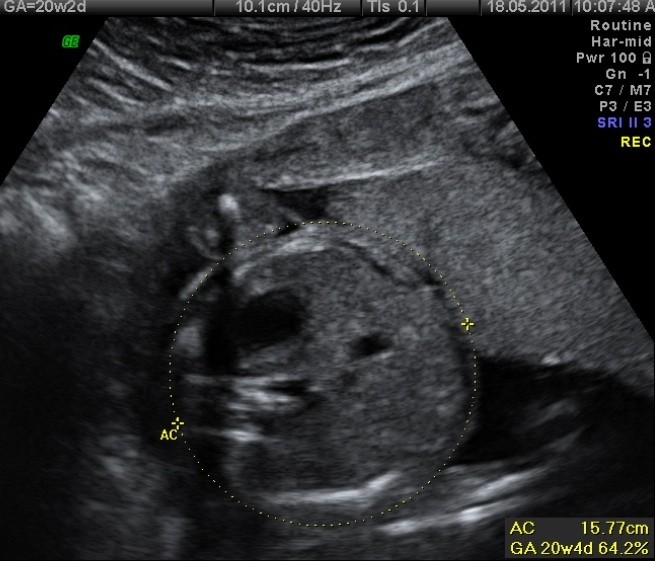 File:Normal fetal biometry - second trimester (Radiopaedia 26450-26580 B 1).jpg