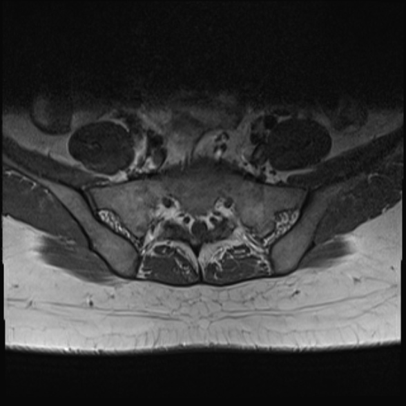 File:Normal lumbar spine MRI- 3 T (Radiopaedia 53280-59250 Axial 33).jpg