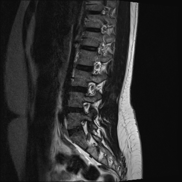 File:Normal lumbar spine MRI- 3 T (Radiopaedia 53280-59250 Sagittal T2 8).jpg
