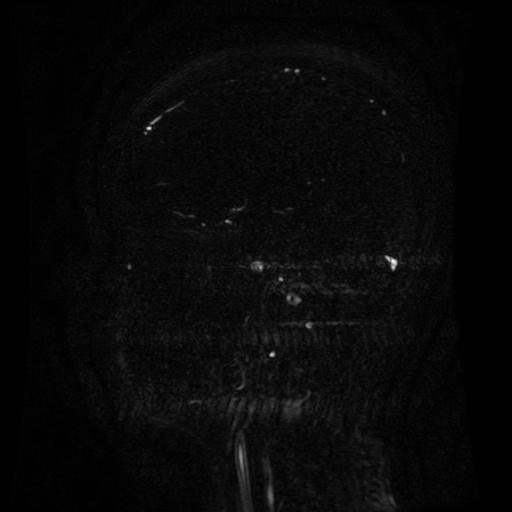 Normal noncontrast MR venography (Radiopaedia 87578-103957 A 112).jpg