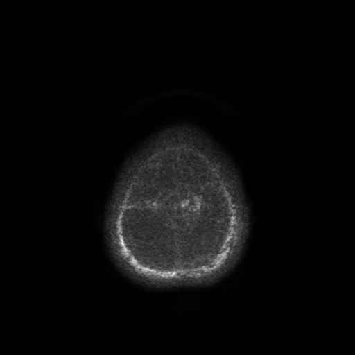 Normal noncontrast MR venography (Radiopaedia 87578-103957 Axial SWI 5).jpg