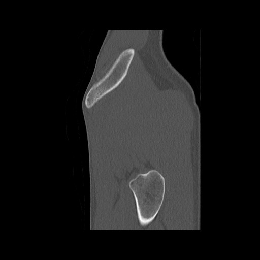 Normal pelvis (Radiopaedia 51473-57238 Sagittal bone window 137).jpg