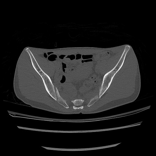 Normal pelvis CT (Radiopaedia 51471-57236 Axial bone window 44).jpg