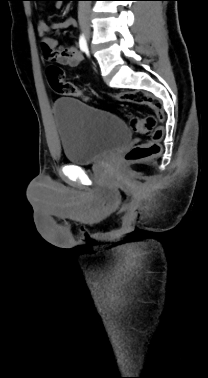 Normal pelvis CT angiogram (Radiopaedia 84966-100481 C 53).jpg