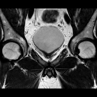 File:Normal prostate (MRI) (Radiopaedia 29986-30535 Coronal T2 6).jpg