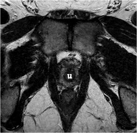 File:Normal prostate (MRI) (Radiopaedia 29986-30536 A 4).png