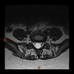 File:Normal spine MRI (Radiopaedia 77323-89408 Axial T2 23).jpg