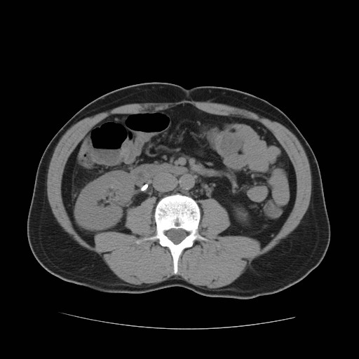 File:Obstructed kidney with perinephric urinoma (Radiopaedia 26889-27067 Axial non-contrast 1).jpg