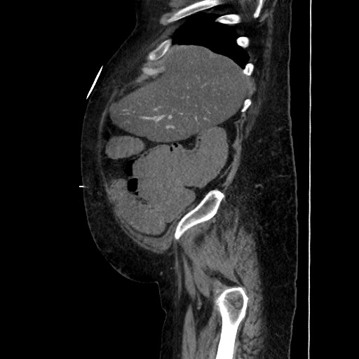 Obstructive colonic diverticular stricture (Radiopaedia 81085-94675 C 53).jpg
