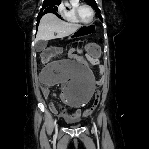 Obstructive distal colonic adenocarcinoma causing cecal perforation (Radiopaedia 86830-102989 C 74).jpg