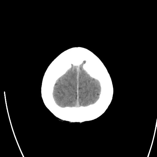 File:Obstructive hydrocephalus (Radiopaedia 30453-31119 Axial non-contrast 26).jpg