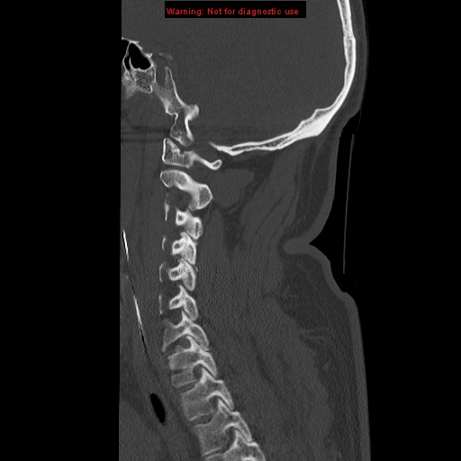 File:Occipital condyle fracture (Radiopaedia 18366-18208 Sagittal bone window 25).jpg