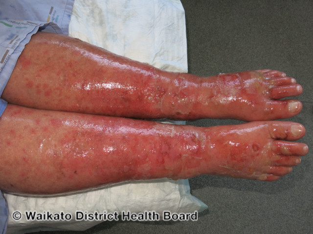 File:Toxic epidermal necrolysis (DermNet NZ drug-reaction-300).jpg