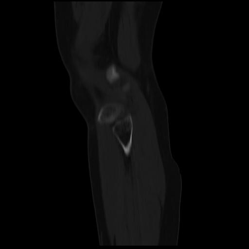 File:ACL avulsion fracture (Radiopaedia 33833-34994 Sagittal bone window 6).jpg