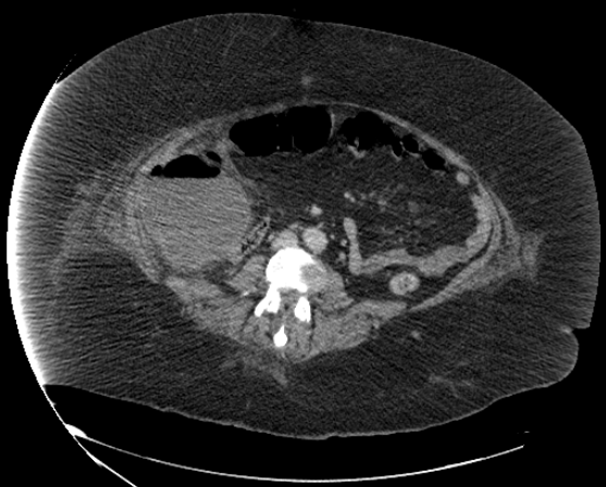 File:Abdominal abscess - pre and post percutaneous drainage (Radiopaedia 60209-67816 Axial 20).png
