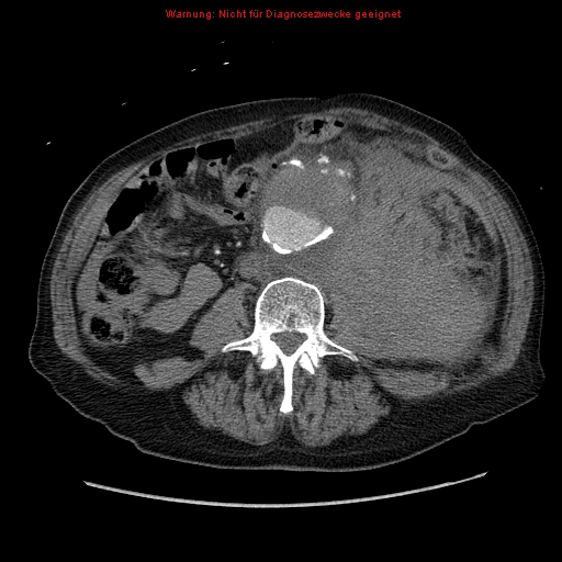 File:Abdominal aortic aneurysm- extremely large, ruptured (Radiopaedia 19882-19921 Axial C+ arterial phase 42).jpg