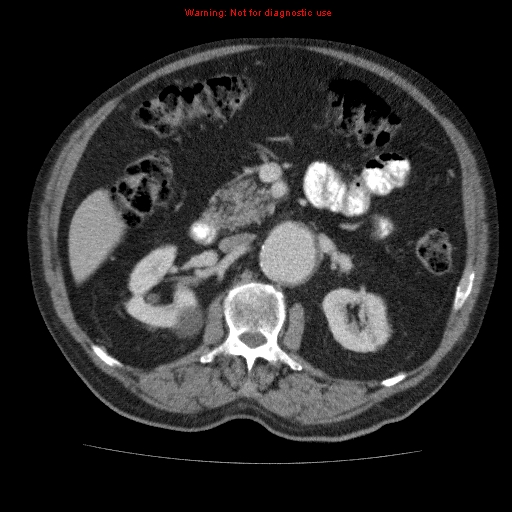 File:Abdominal aortic aneurysm (Radiopaedia 10122-10660 Axial C+ portal venous phase 29).jpg