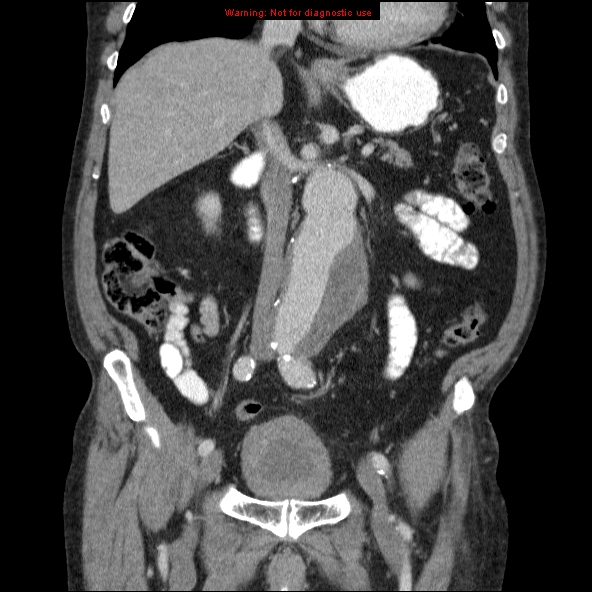 File:Abdominal aortic aneurysm (Radiopaedia 10122-10660 Coronal C+ portal venous phase 20).jpg