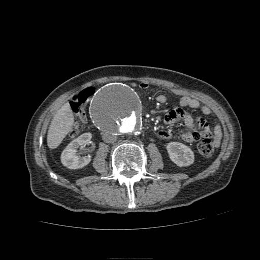 File:Abdominal aortic aneurysm (Radiopaedia 13341-13340 Axial C+ arterial phase 101).jpg