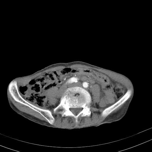 File:Abdominal aortic aneurysm (Radiopaedia 20827-20742 Axial C+ arterial phase 23).jpg