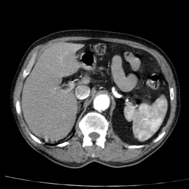 Abdominal aortic aneurysm (Radiopaedia 29248-29660 Axial C+ arterial phase 21).jpg