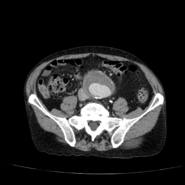 Abdominal aortic aneurysm (Radiopaedia 29248-29660 Axial C+ portal venous phase 42).jpg