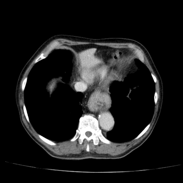 Abdominal aortic aneurysm (Radiopaedia 29248-29660 Axial C+ portal venous phase 8).jpg