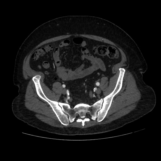 File:Abdominal aortic aneurysm (Radiopaedia 57318-64259 Axial C+ arterial phase 57).jpg