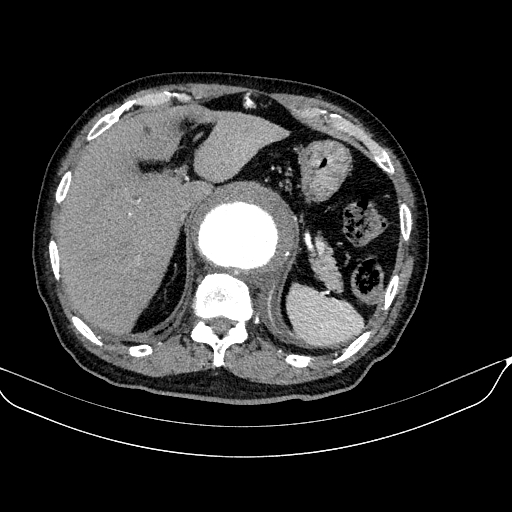 Abdominal aortic aneurysm (Radiopaedia 67117-76452 Axial C+ arterial phase 30).jpg