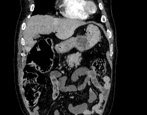 Abdominal aortic aneurysm (Radiopaedia 67117-76452 Coronal C+ arterial phase 10).jpg