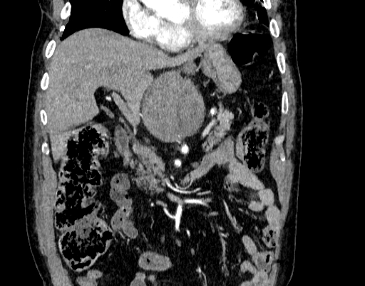Abdominal aortic aneurysm (Radiopaedia 67117-76452 Coronal C+ arterial phase 27).jpg