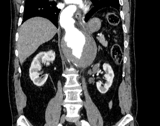 Abdominal aortic aneurysm (Radiopaedia 67117-76452 Coronal C+ arterial phase 60).jpg
