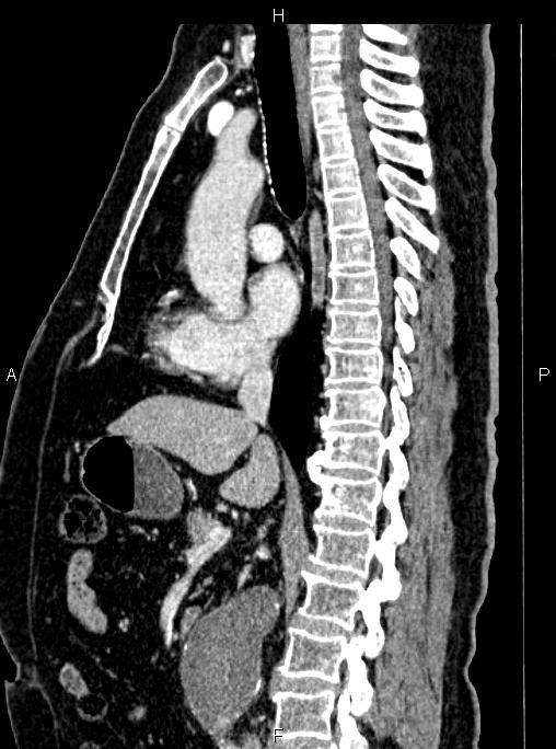 Abdominal aortic aneurysm (Radiopaedia 83094-97462 Sagittal renal cortical phase 62).jpg