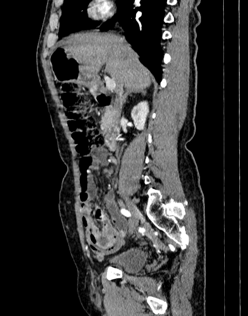 Abdominal aortic aneurysm (Radiopaedia 83581-98689 Sagittal C+ arterial phase 17).jpg