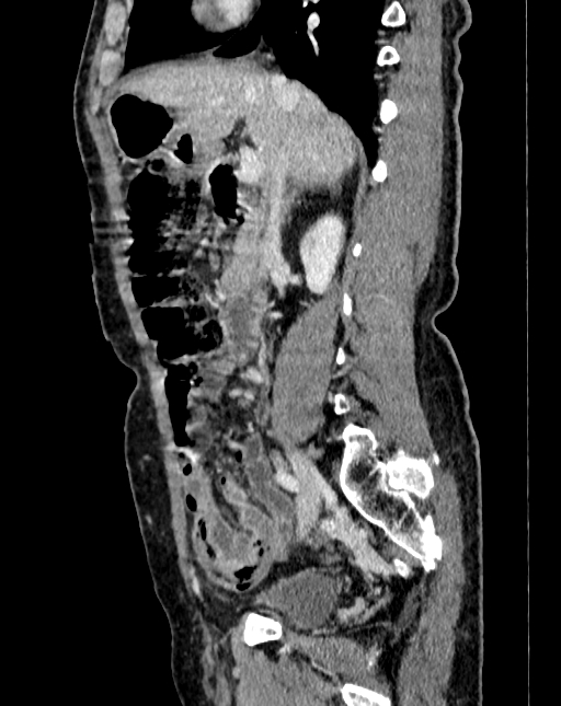 Abdominal aortic aneurysm (Radiopaedia 83581-98689 Sagittal C+ portal venous phase 21).jpg