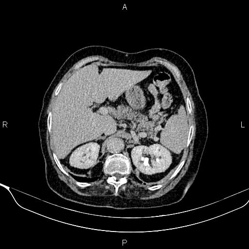 Abdominal aortic aneurysm (Radiopaedia 85063-100606 Axial C+ delayed 17).jpg