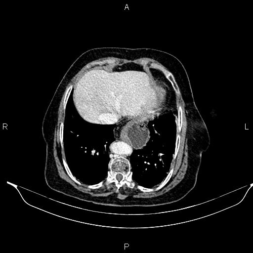 File:Abdominal aortic aneurysm (Radiopaedia 85063-100606 Axial C+ portal venous phase 26).jpg