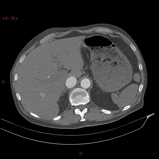 Abdominal aortic aneurysm rupture with aortocaval fistula (Radiopaedia 14897-14841 Axial C+ arterial phase 78).jpg