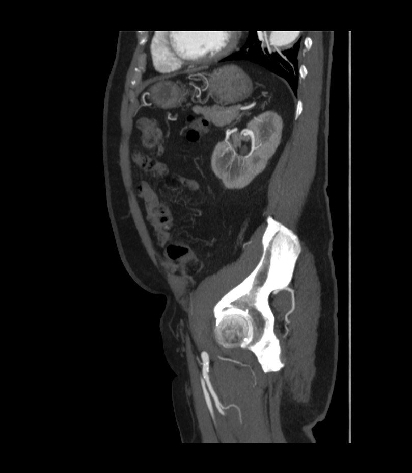 Abdominal aortic aneurysm with thrombus fissuration (Radiopaedia 46218-50618 Sagittal C+ arterial phase 43).jpg