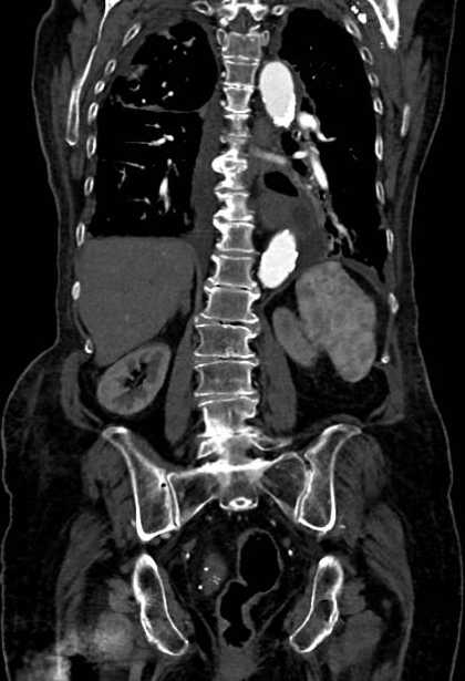 Abdominal aortic aneurysm with thrombus fissuration (Radiopaedia 73192-83919 Coronal C+ arterial phase 61).jpg