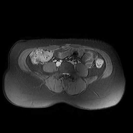 File:Abdominal wall endometriosis (Radiopaedia 83702-98847 Axial T1 C+ fat sat 14).jpg