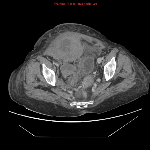 File:Abdominal wall hematoma (Radiopaedia 9427-10112 Axial C+ portal venous phase 94).jpg