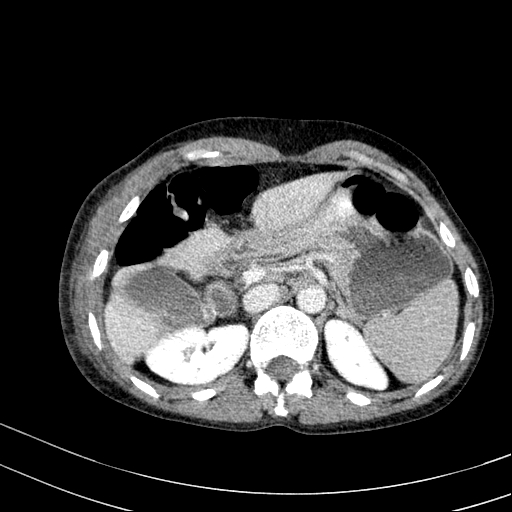 Abdominal wall hematoma with active bleeding (Radiopaedia 83915-99117 Axial C+ portal venous phase 5).jpg